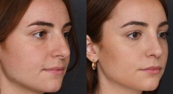 5 Best Rhinoplasty Surgeons in Istanbul for a Beautiful Transformation