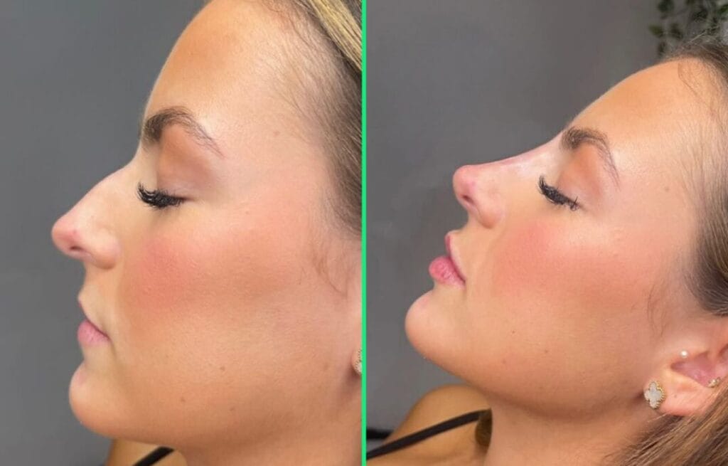 Before and after rhinoplasty showing affordable rhinoplasty cost in Turkey at Vivid Clinic.