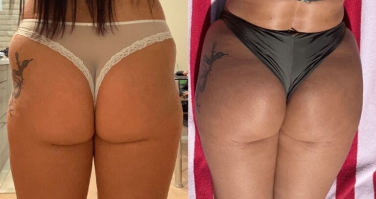 Close-up comparison showing where BBL incisions and scars are placed