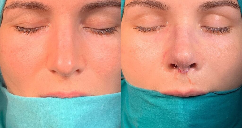 Expert rhinoplasty surgeons in Istanbul using the latest technology to achieve balanced and natural results.

