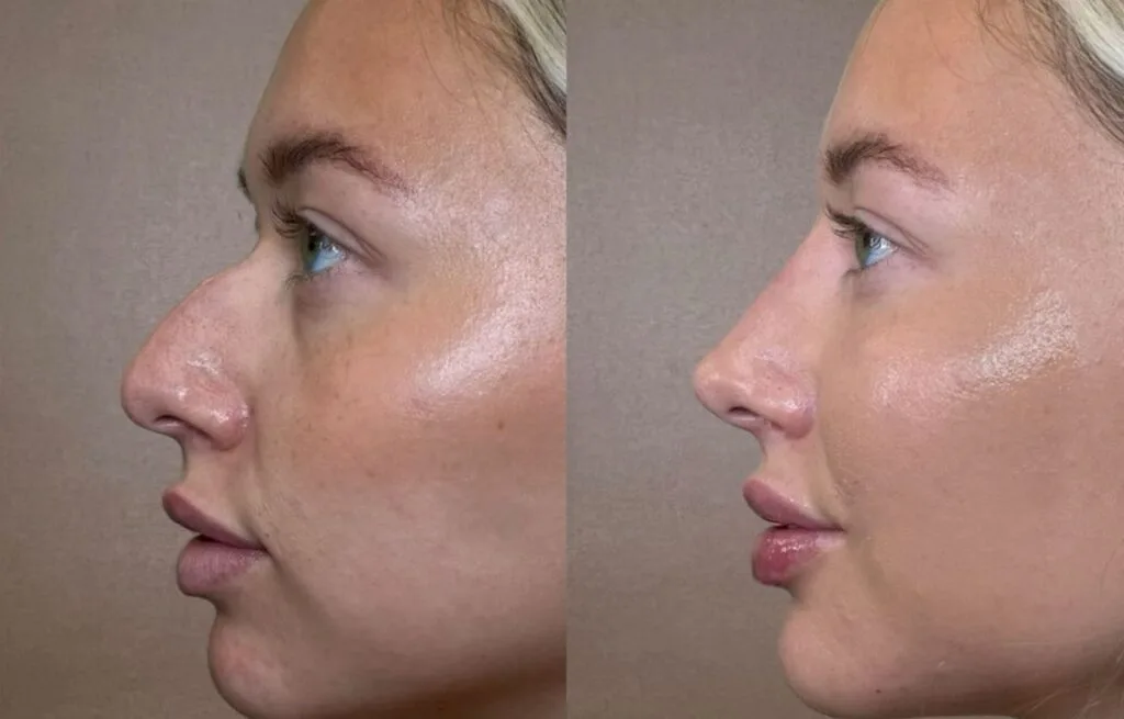 Before and after rhinoplasty results showing a reshaped nose.