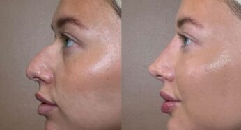 10 Essential Facts About Rhinoplasty Nose Job Nose Surgery Cost You Need to Know