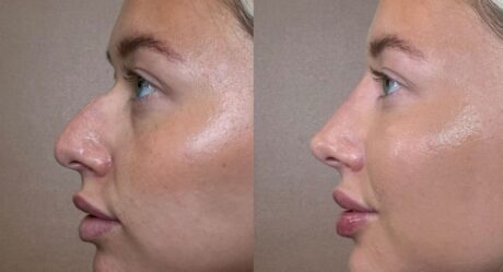 10 Essential Facts About Rhinoplasty Nose Job Nose Surgery Cost You Need to Know