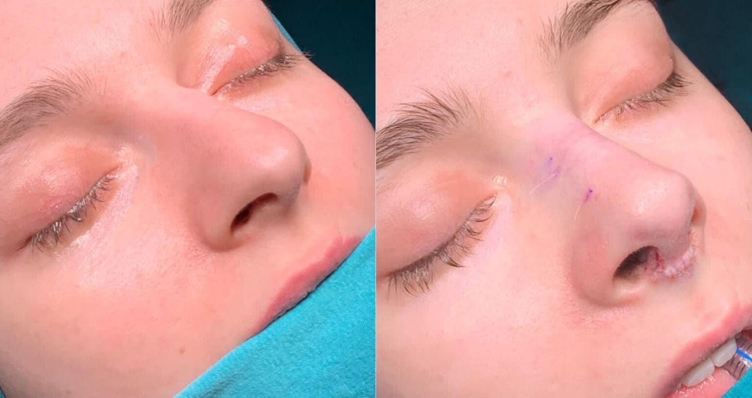 İstanbul'un en iyi rinoplasti cerrahı Vivid Clinic'te ileri düzey burun şekillendirme ameliyatı gerçekleştiriyor.