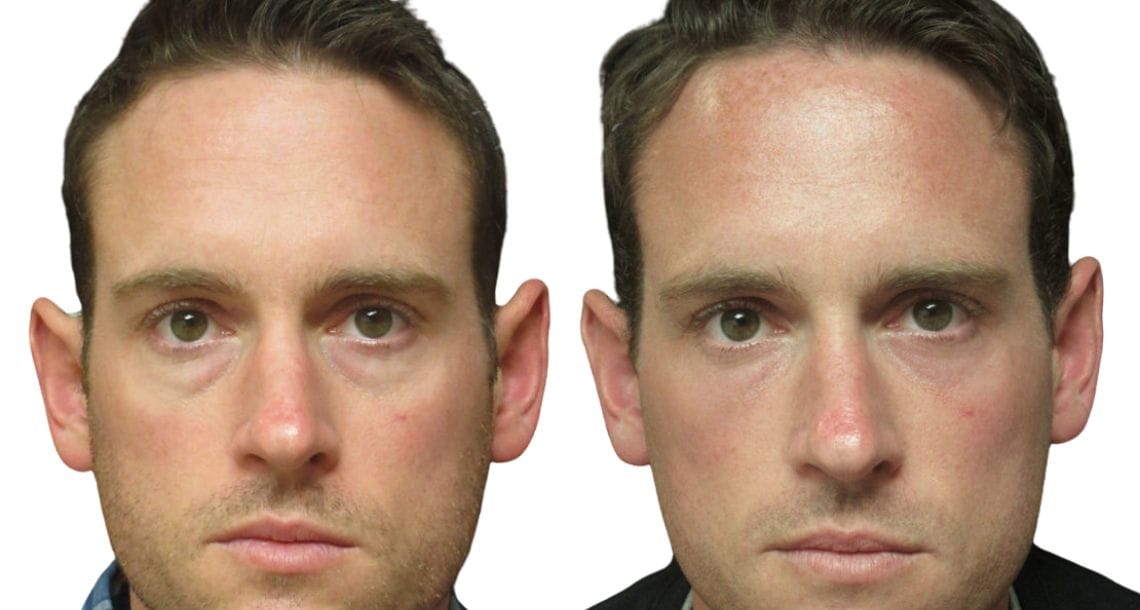 Male patient before and after upper and lower blepharoplasty.