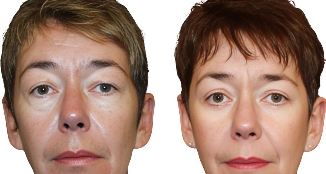 Before and after photos of a woman who underwent upper blepharoplasty.