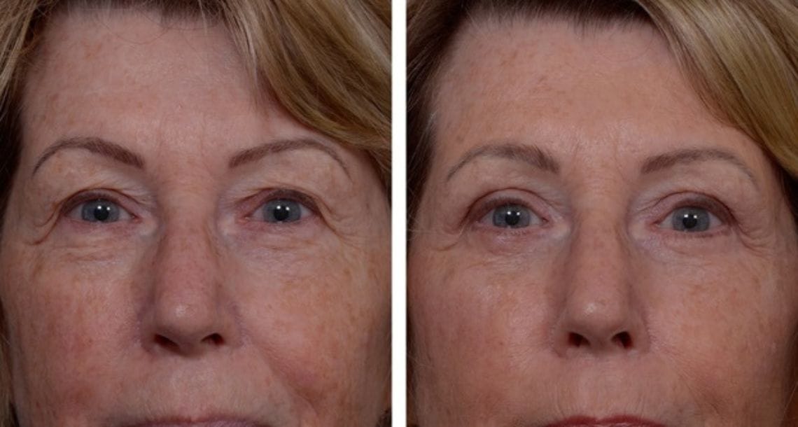 Dramatic improvement in eye appearance after blepharoplasty.