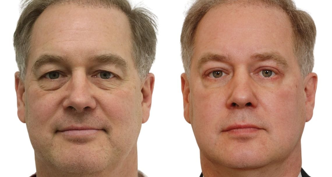 Before and after lower blepharoplasty for a male patient.