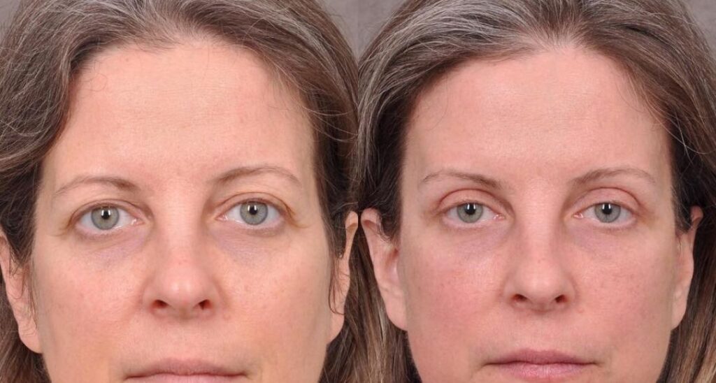 Blefaroplastia para párpados encapuchados antes y después.