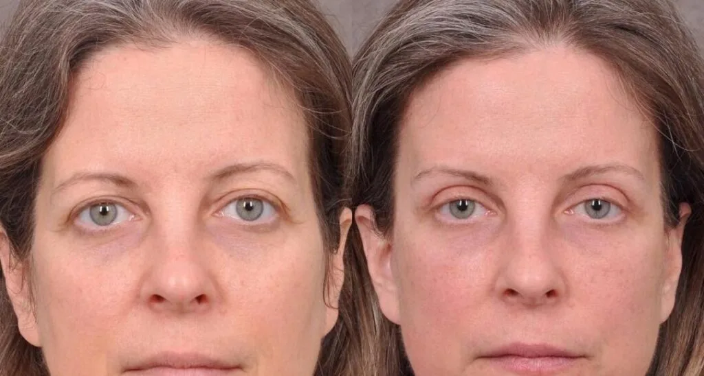 أكثر من 10 صور مذهلة قبل وبعد عملية تجميل الجفون: شاهد نتائج حقيقية للمرضى 🤯 عملية تجميل الجفون المترهلة قبل وبعد.