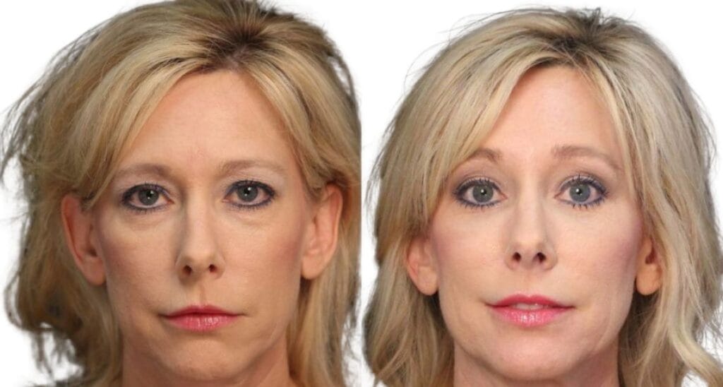 Fotos de antes y después de blefaroplastia que muestran un aspecto más despierto.