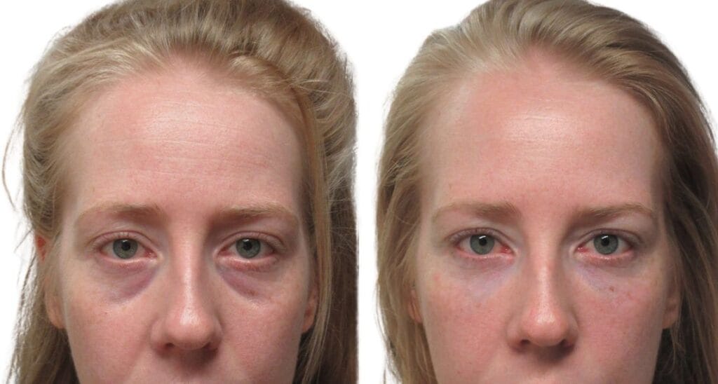 Fotos de antes y después de una mujer que se sometió a una blefaroplastia superior e inferior.