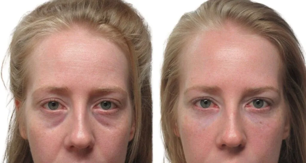 أكثر من 10 صور مذهلة قبل وبعد عملية تجميل الجفون: شاهد نتائج حقيقية للمرضى 🤯 صور قبل وبعد لامرأة خضعت لجراحة تجميل الجفون العلوية والسفلية.