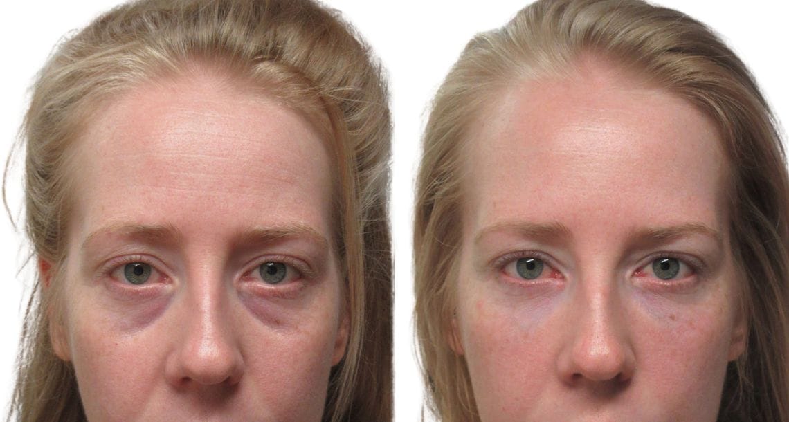 Before and after photos of a woman who had upper and lower blepharoplasty.