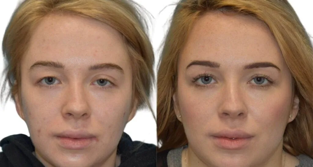 Blepharoplasty results showing improved eye shape and contour.