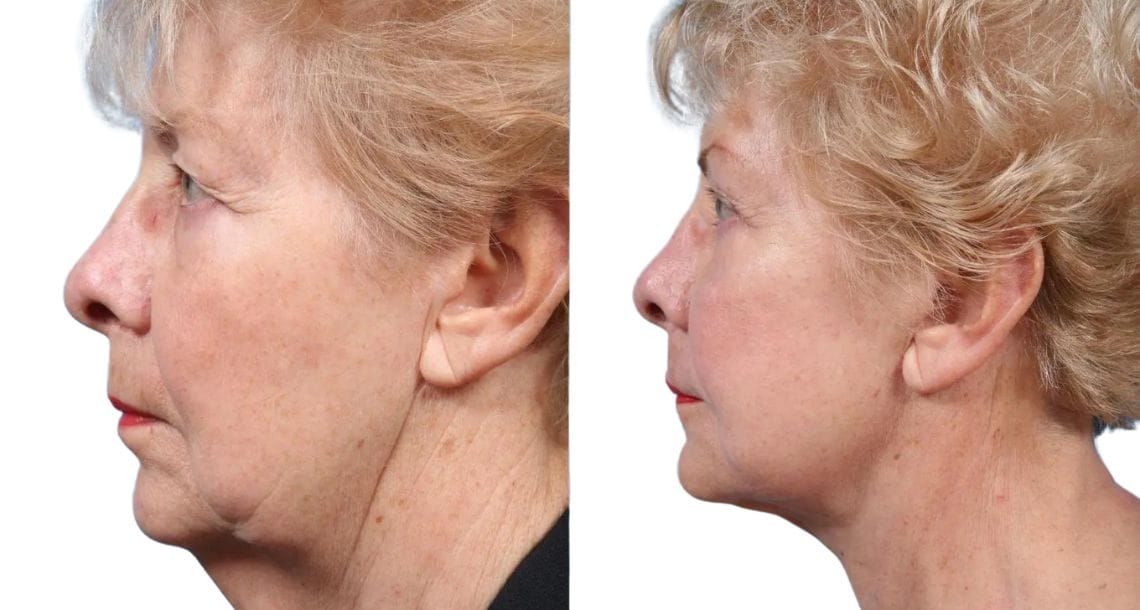 Before and after photos of a female patient who underwent a neck lift at Vivid Clinic.