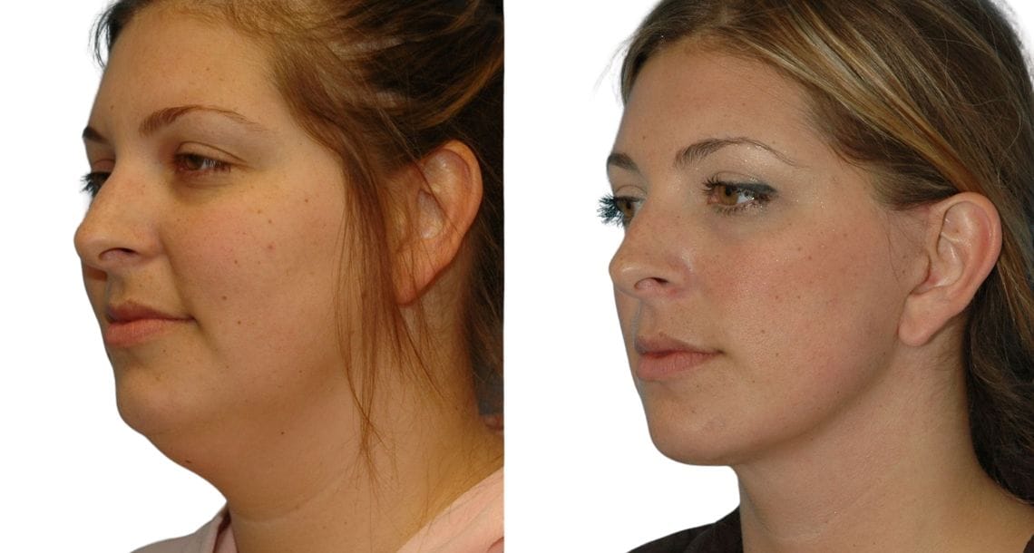 Before and after images of a woman who had a neck lift to reduce sagging skin and wrinkles.