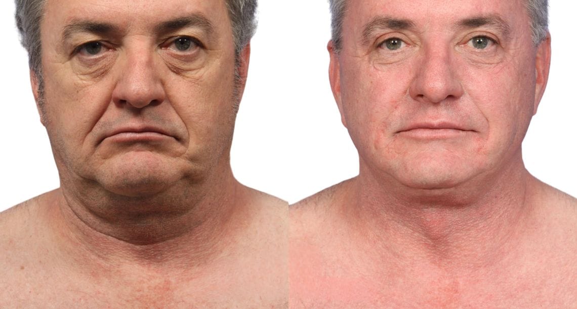 Male patient before and after neck lift surgery, showing improvement in jawline definition.