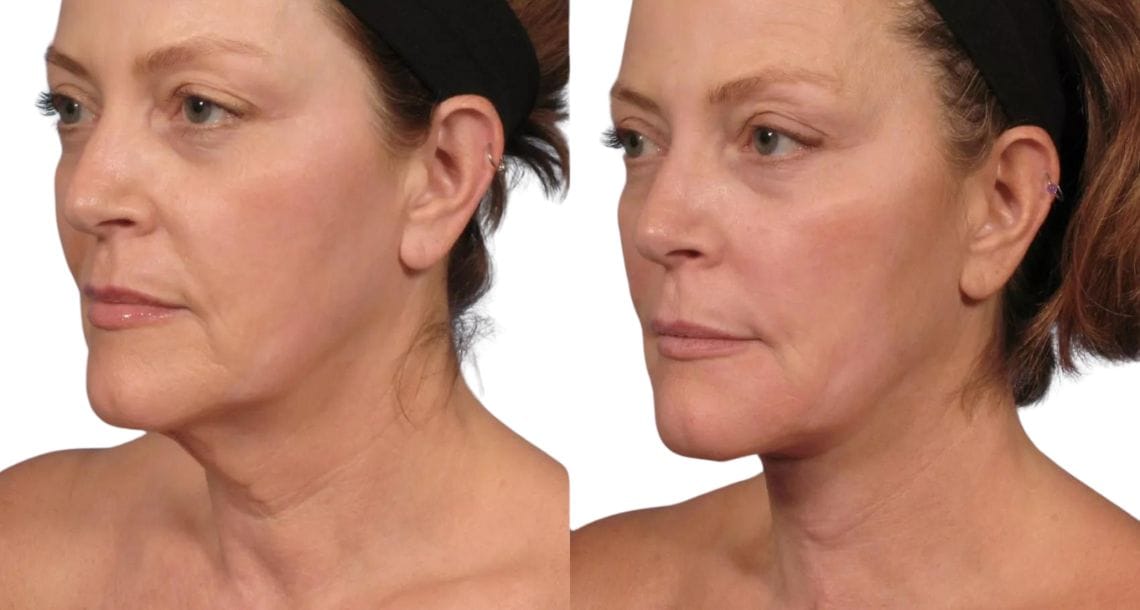 Before and after photos of a woman with improved neck contour and reduced "turkey neck" after a neck lift.