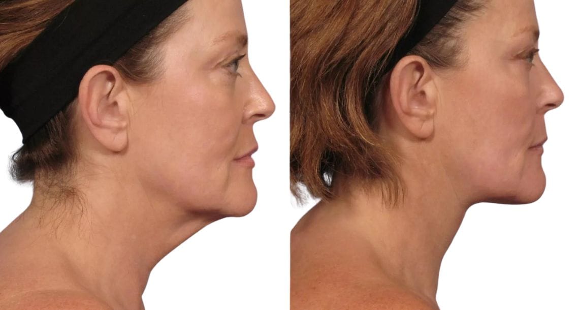 Before and after photos of a woman with improved neck contour and reduced "turkey neck" after a neck lift.