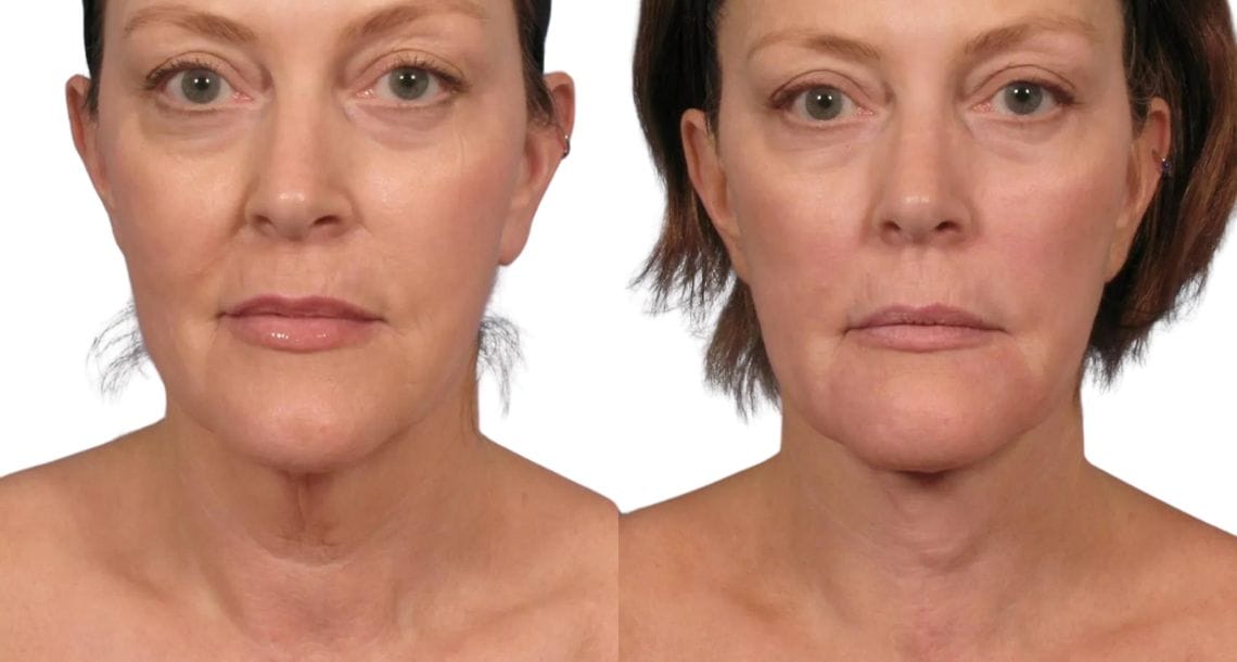 Before and after photos of a woman with improved neck contour and reduced "turkey neck" after a neck lift.