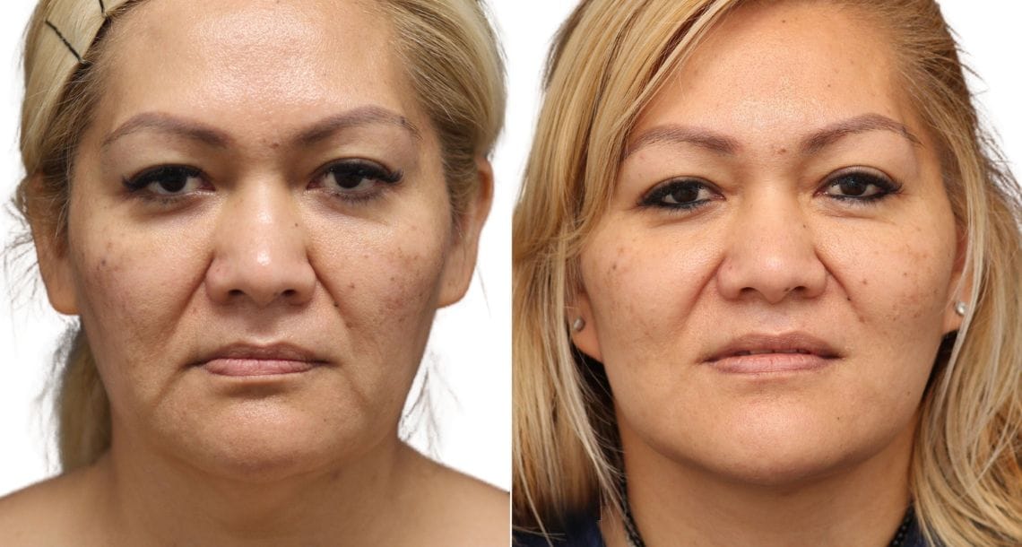 Female patient with a more youthful and refreshed appearance after a neck lift at Vivid Clinic.