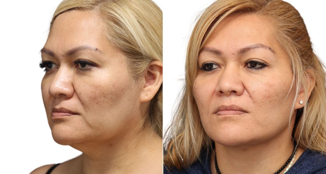 Female patient with a more youthful and refreshed appearance after a neck lift at Vivid Clinic.