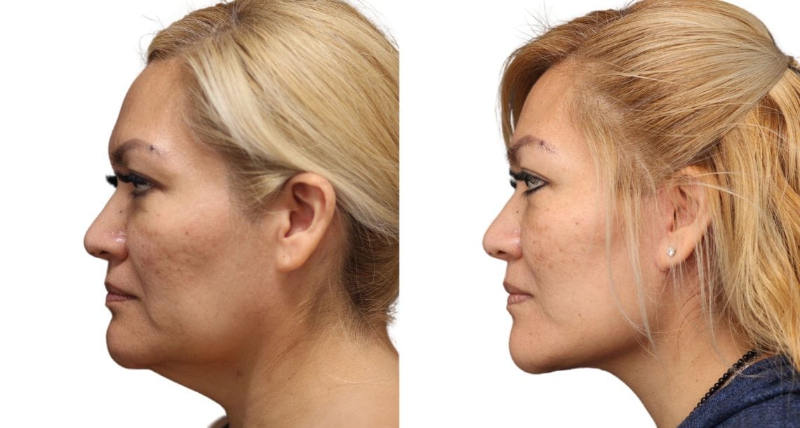 Female patient with a more youthful and refreshed appearance after a neck lift at Vivid Clinic.