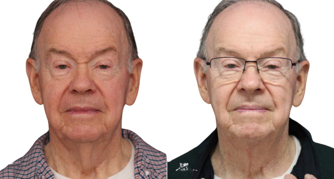 Male patient with a firmer and more youthful neck after undergoing a neck lift.