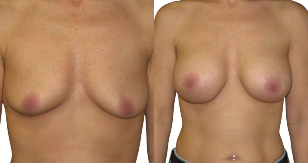 Before and After Breast Augmentation in Istanbul - Enhanced Shape