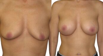 Discover the Incredible Cost of Breast Augmentation in Istanbul: Affordable Transformation Awaits!