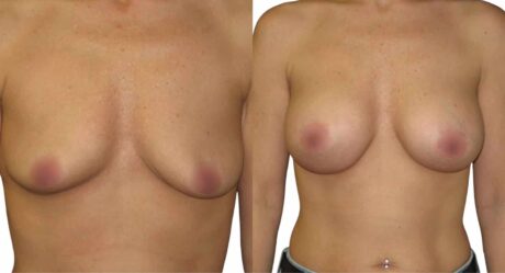Discover the Incredible Cost of Breast Augmentation in Istanbul: Affordable Transformation Awaits!
