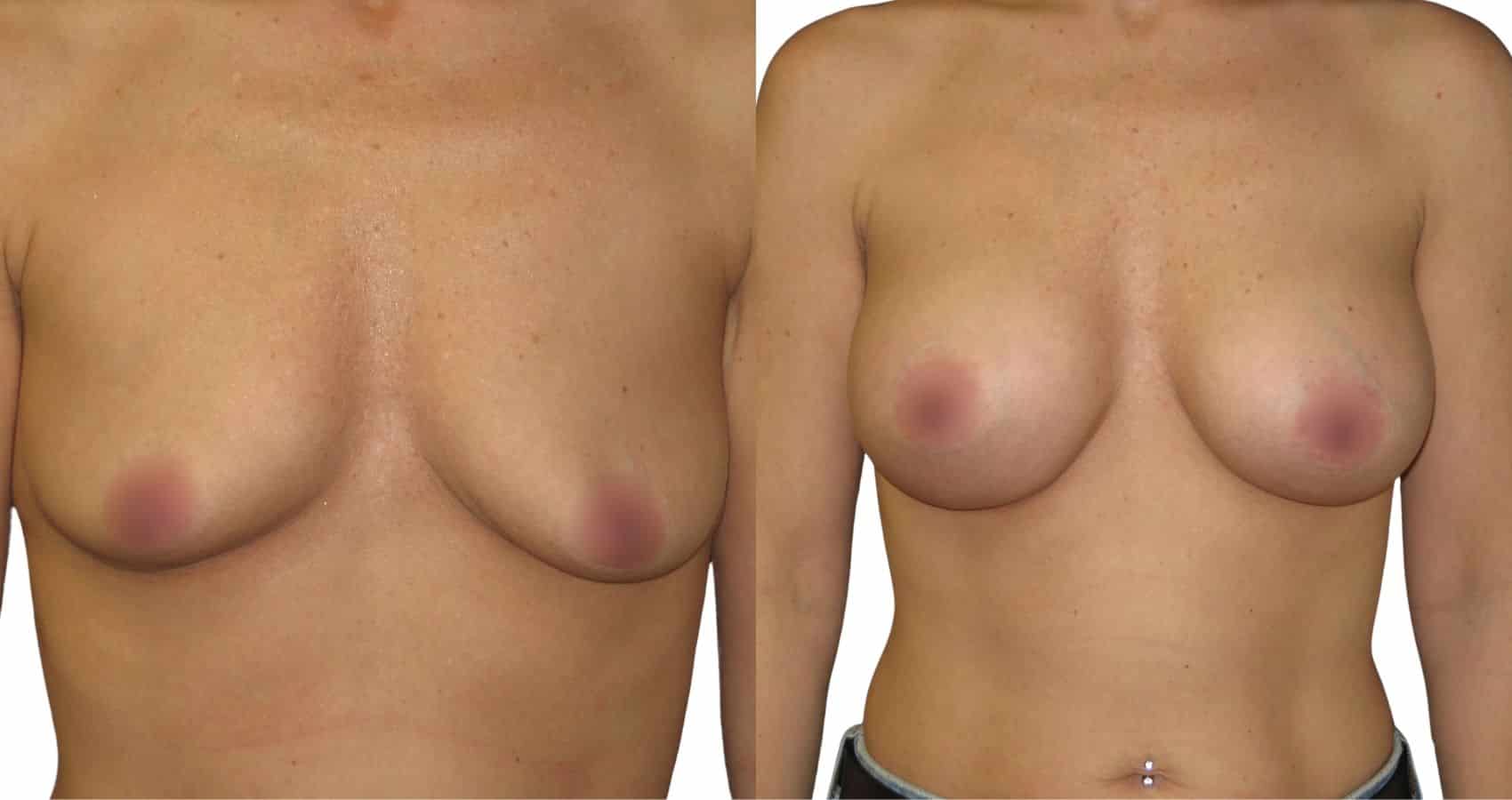 Discover the Incredible Cost of Breast Augmentation in Istanbul: Affordable Transformation Awaits!