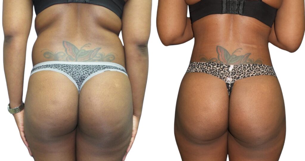 Brazilian Butt Lift before and after with increased projection and definition.