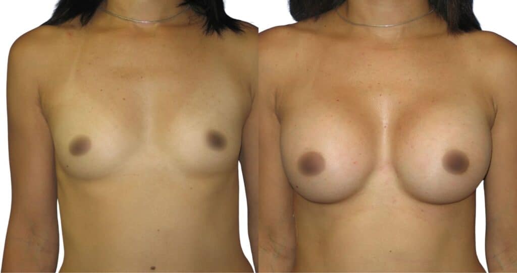 Natural-Looking Results After Breast Augmentation in Istanbul