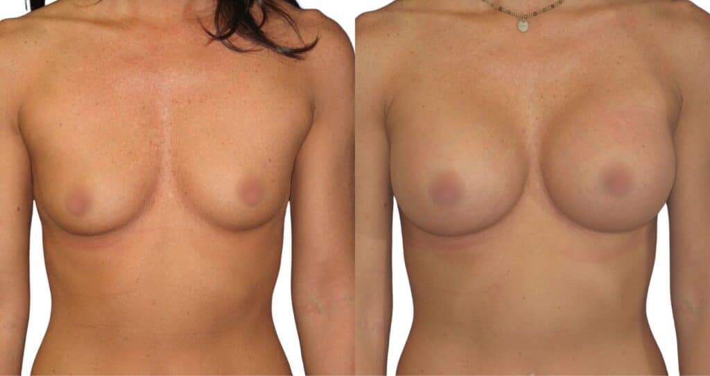 Breast Augmentation Istanbul - Affordable Transformation