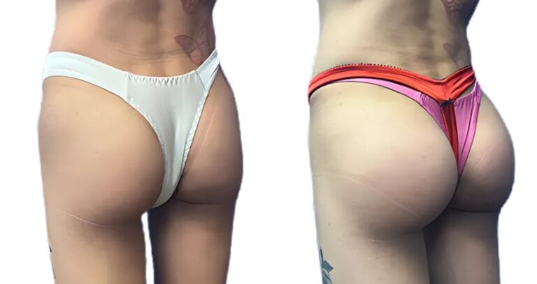 What Does BBL Stand For? Side close-up before and after composite of a BBL, showing lower-body contour change