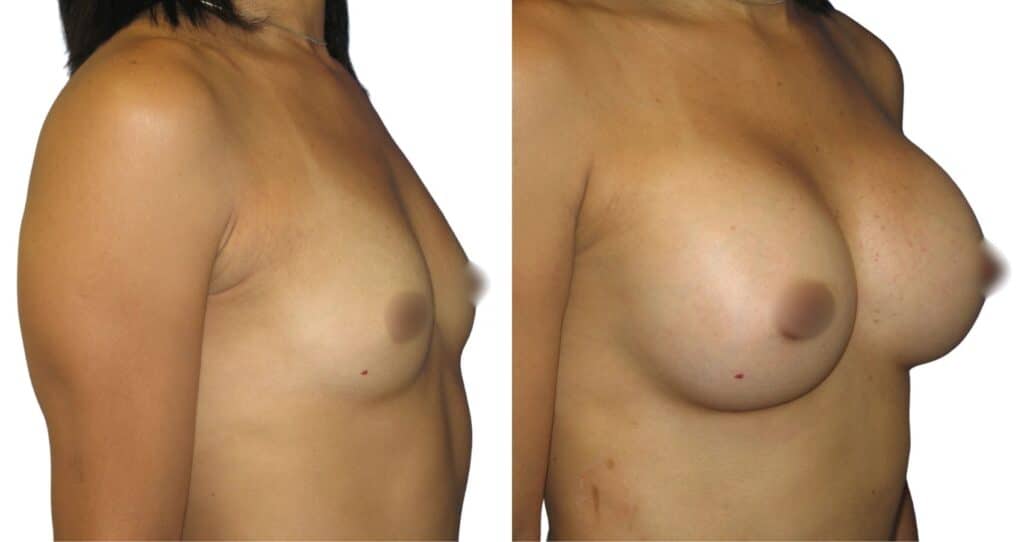 Silicone Implants Before and After Breast Augmentation in Istanbul