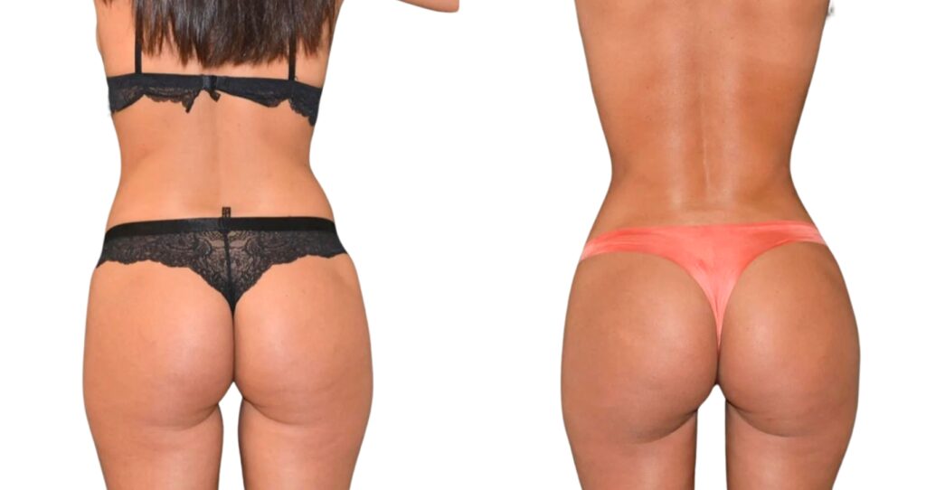 Before and after images of a Brazilian Butt Lift showing enhanced volume and contour.