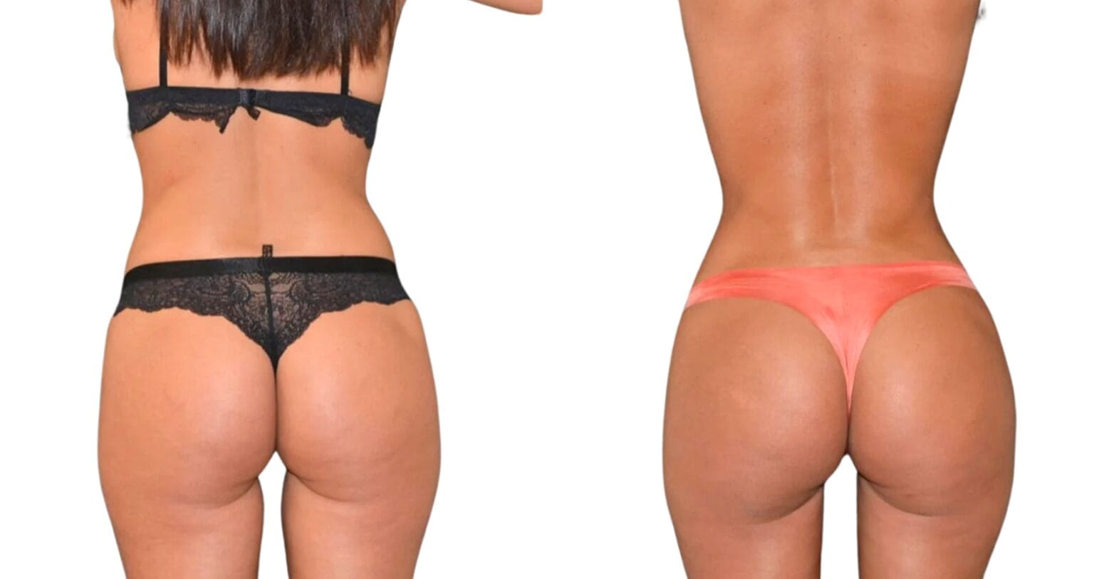 Immagini del prima e del dopo di un lifting brasiliano dei glutei che ne evidenziano volume e contorni migliorati.
