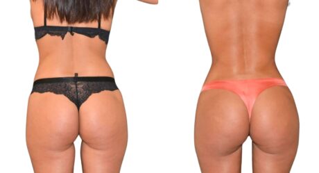 10 أسباب قوية لاختيار تركيا لعملية تكبير الأرداف البرازيلية (BBL) في عام 2024