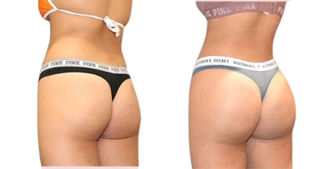 Patient transformation before and after Brazilian Butt Lift with subtle volume enhancement.