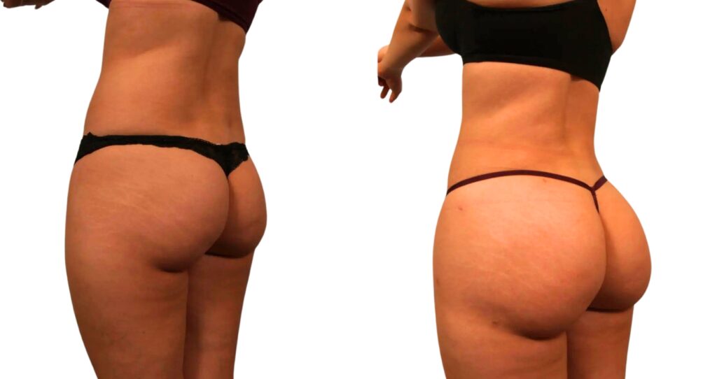 Brazilian Butt Lift before and after showing results of fat transfer technique.