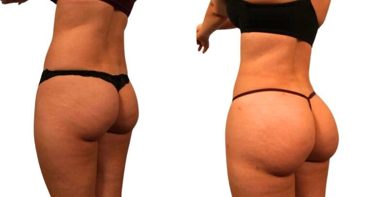 Lifting brasiliano dei glutei prima e dopo che mostra i risultati della tecnica di trasferimento del grasso.
