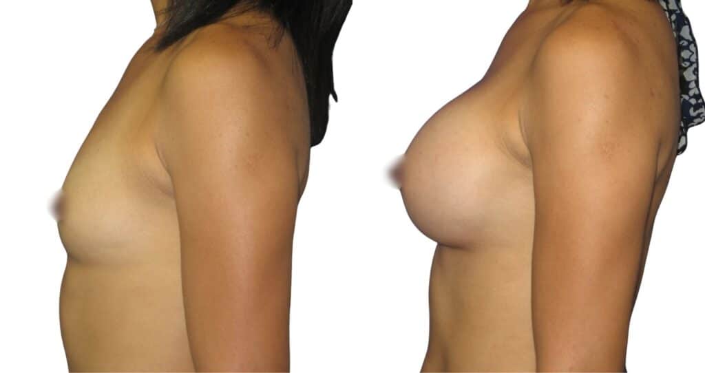 Breast Augmentation Before and After Recovery in Istanbul