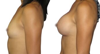 The Best Clinics for Breast Augmentation in Turkey: Your Ultimate Guide to Top-Rated Care