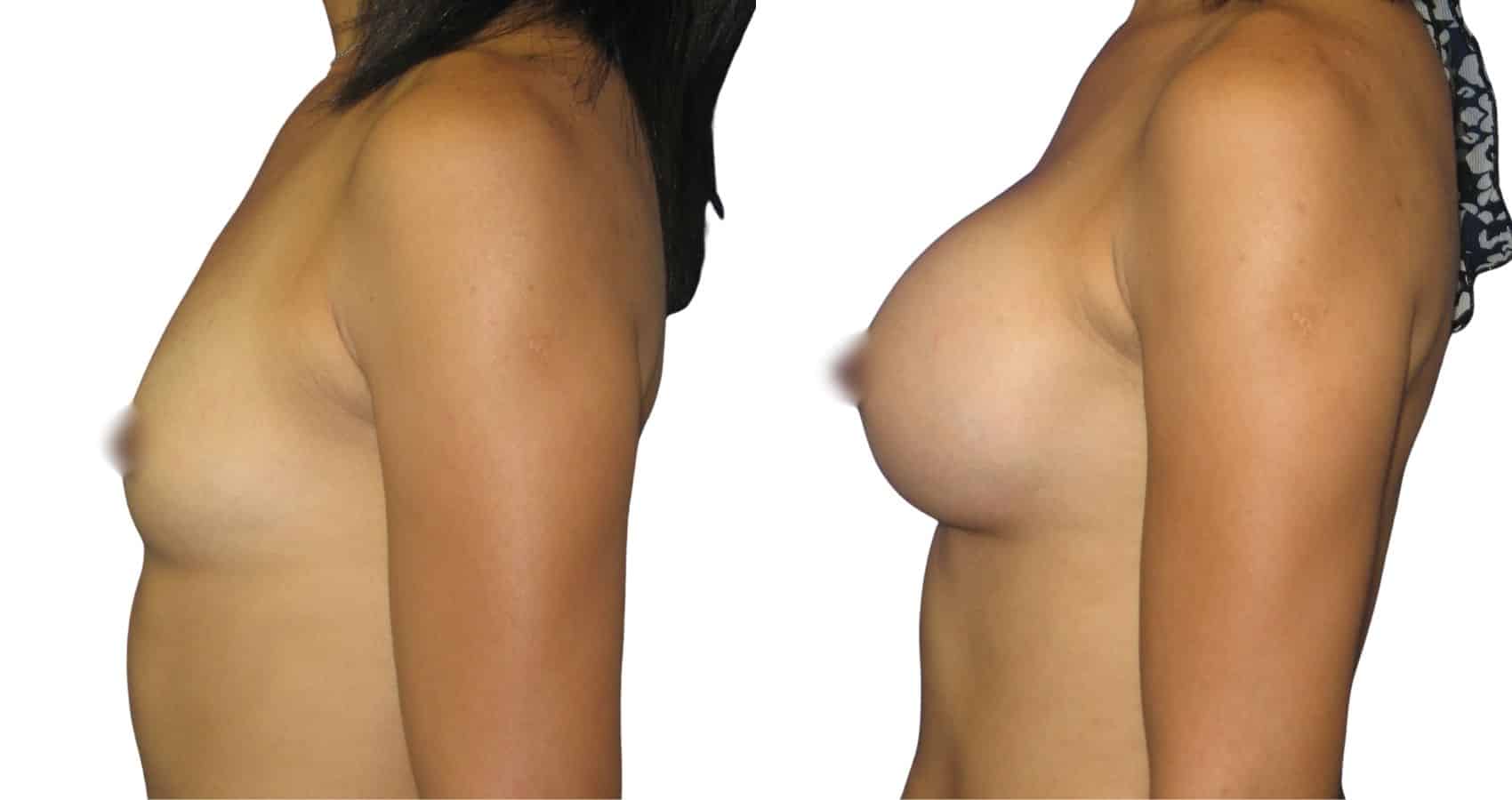 The Best Clinics for Breast Augmentation in Turkey: Your Ultimate Guide to Top-Rated Care