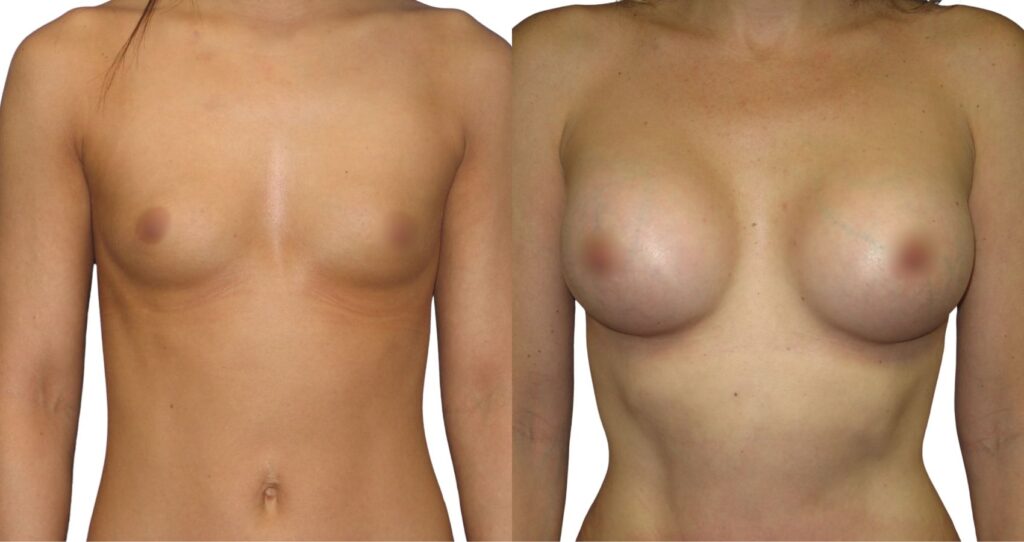 Before and After Affordable Breast Augmentation Turkey