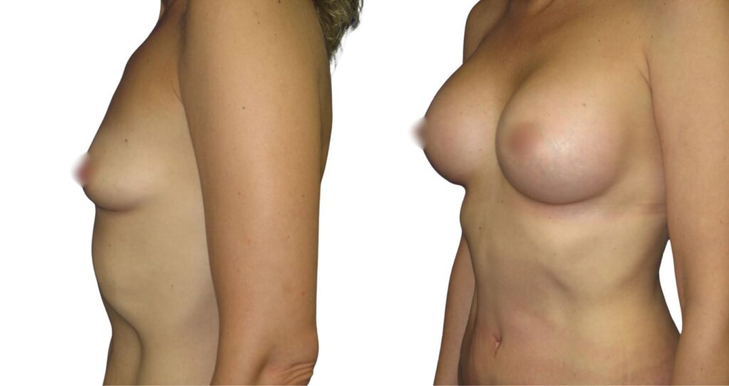 Patient Success Story - Breast Augmentation Istanbul