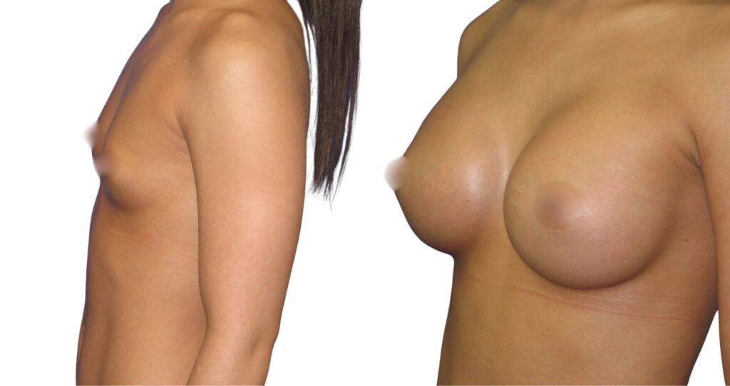 Remarkable Breast Augmentation Results in Istanbul - Vivid Clinic